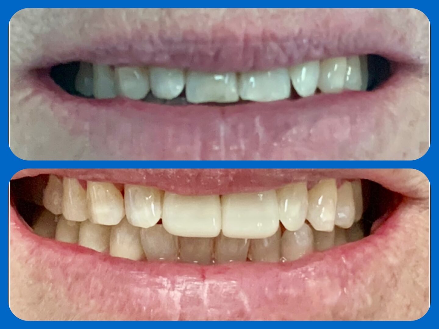 Before and after photos of teeth