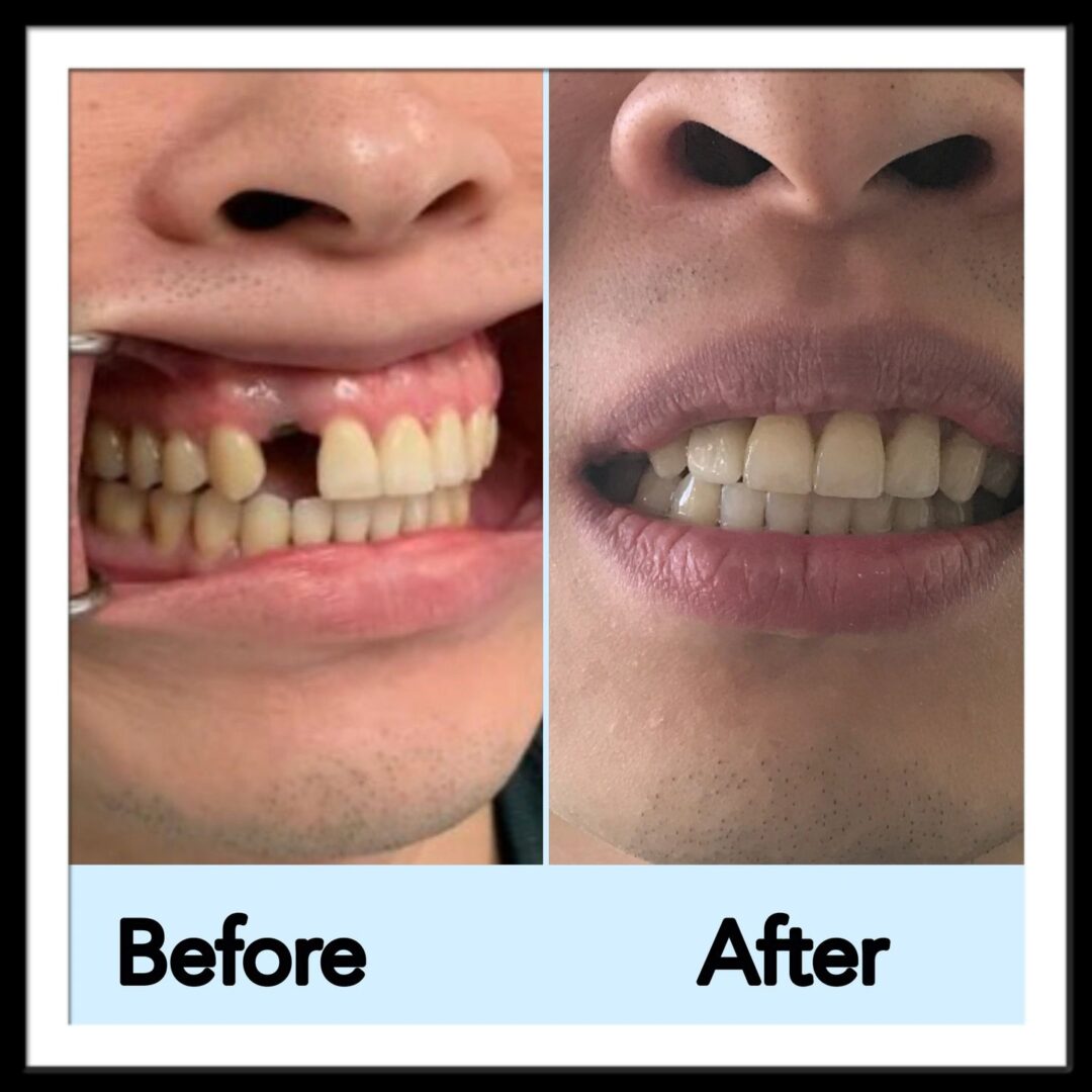 Before and after tooth replacement
